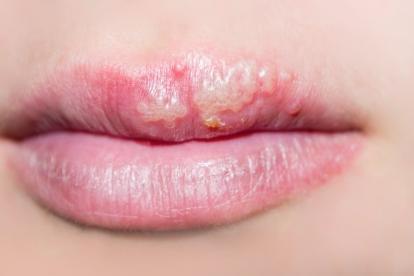 吃脆瓜嘴唇肿,脆瓜诱惑下的嘴唇肿痛之谜