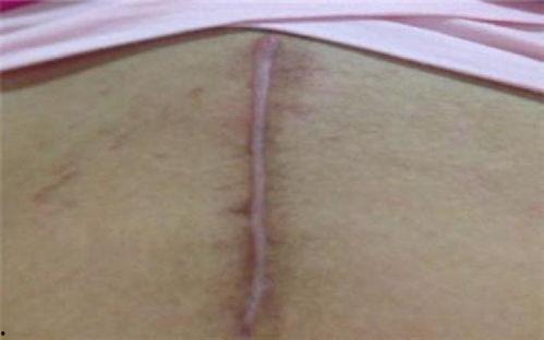 明星剖腹产疤痕图片,勇敢妈妈们的美丽印记